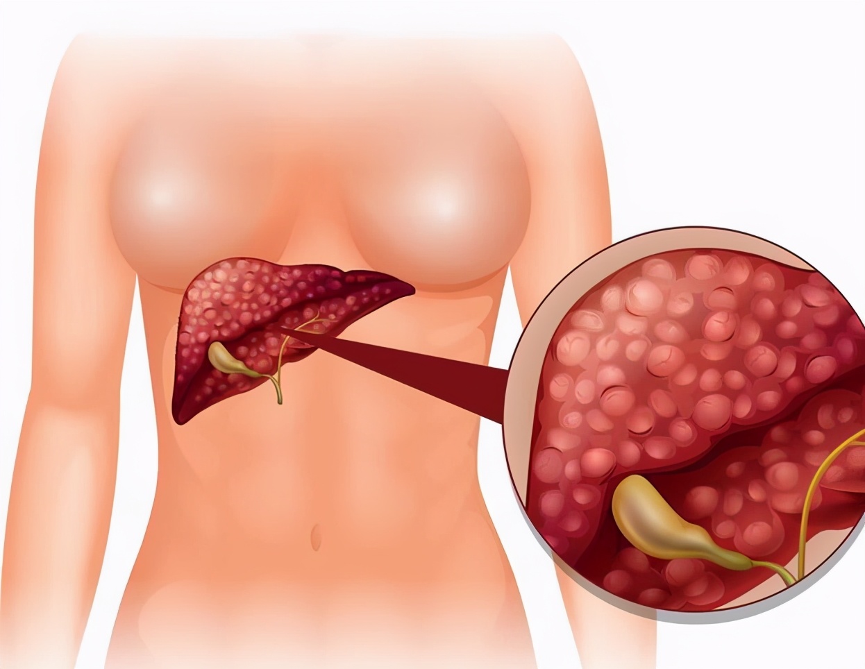 肝癌晚期真的是“无药可治”了吗?不一定,这样做,也可长期生存