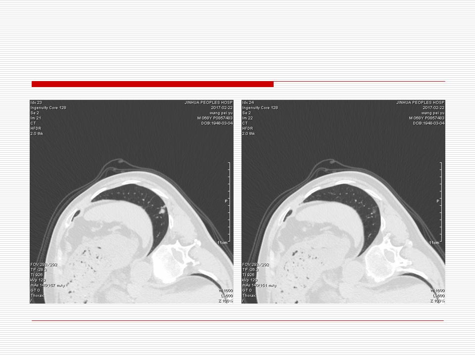 像炎症的肺癌能治好吗,医生说可能是肺癌也可能是炎症