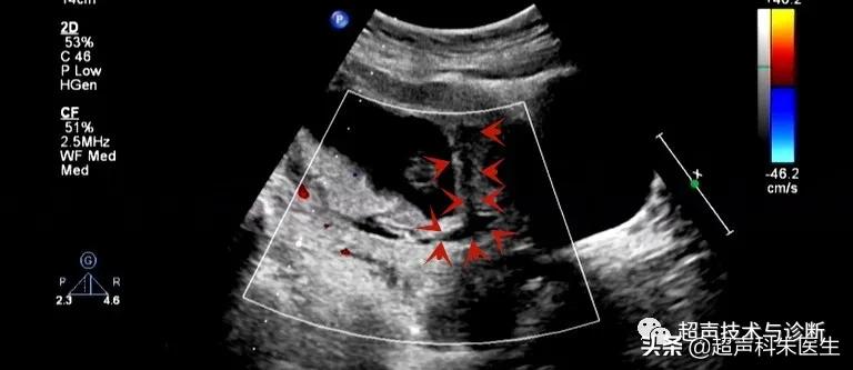 绒毛膜下血肿的超声图像,绒毛膜下血肿一般有啥症状