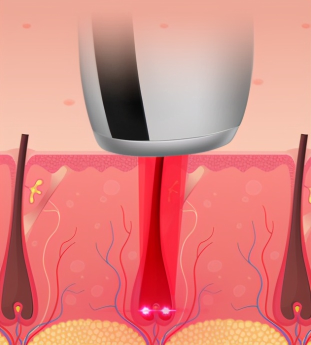 哪种毛适合激光脱毛,最近的激光脱毛