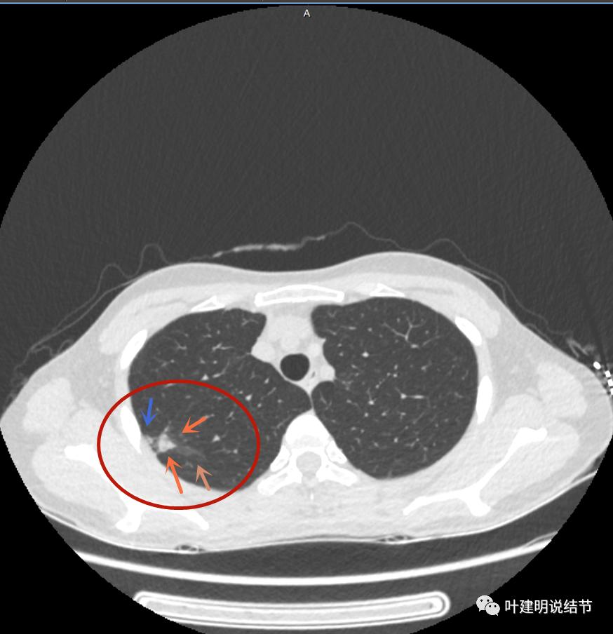 临床诊断孤立性肺结节,空洞型结节一般是什么性质