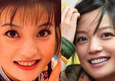 吴宣仪做牙齿前后对比,吴宣仪做整牙