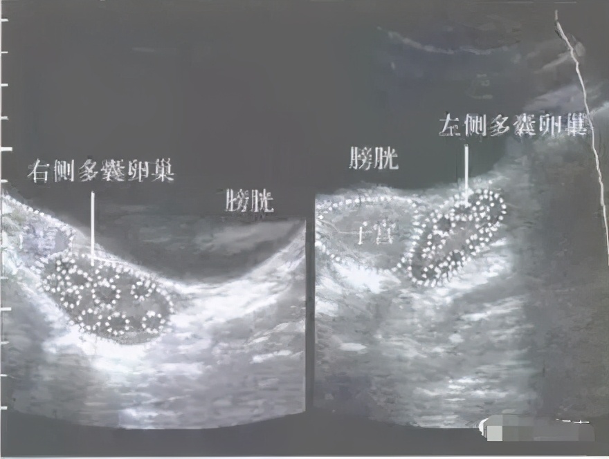 b超显示右卵巢有小囊会是卵泡吗,b超检查卵巢有低回声团块是什么