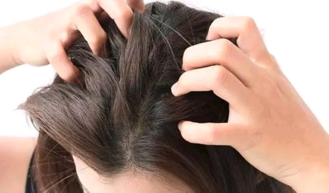 头皮上的白泥有必要除掉吗,头皮上的白泥如何解决