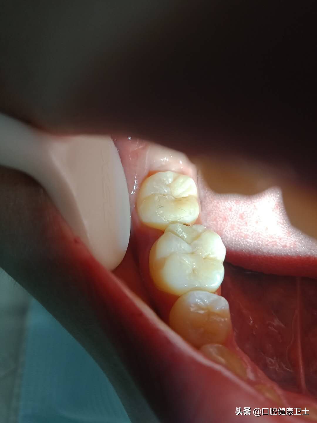 补牙后感觉牙缝被堵上了,补牙后牙缝疼痛是什么原因引起的