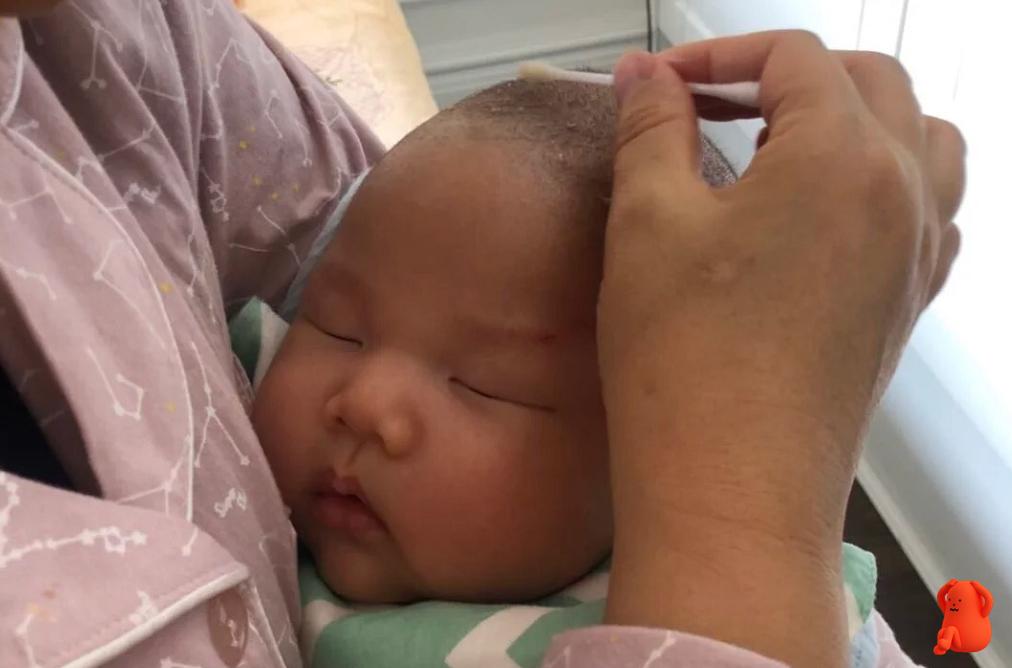 宝宝乳痂怎么去除,手贱扣痂会留印吗