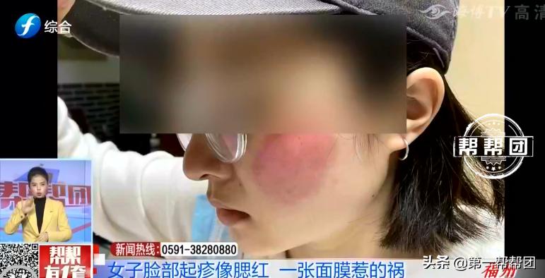 用了面膜皮肤变黑又脱皮,网红面膜变成激素皮炎