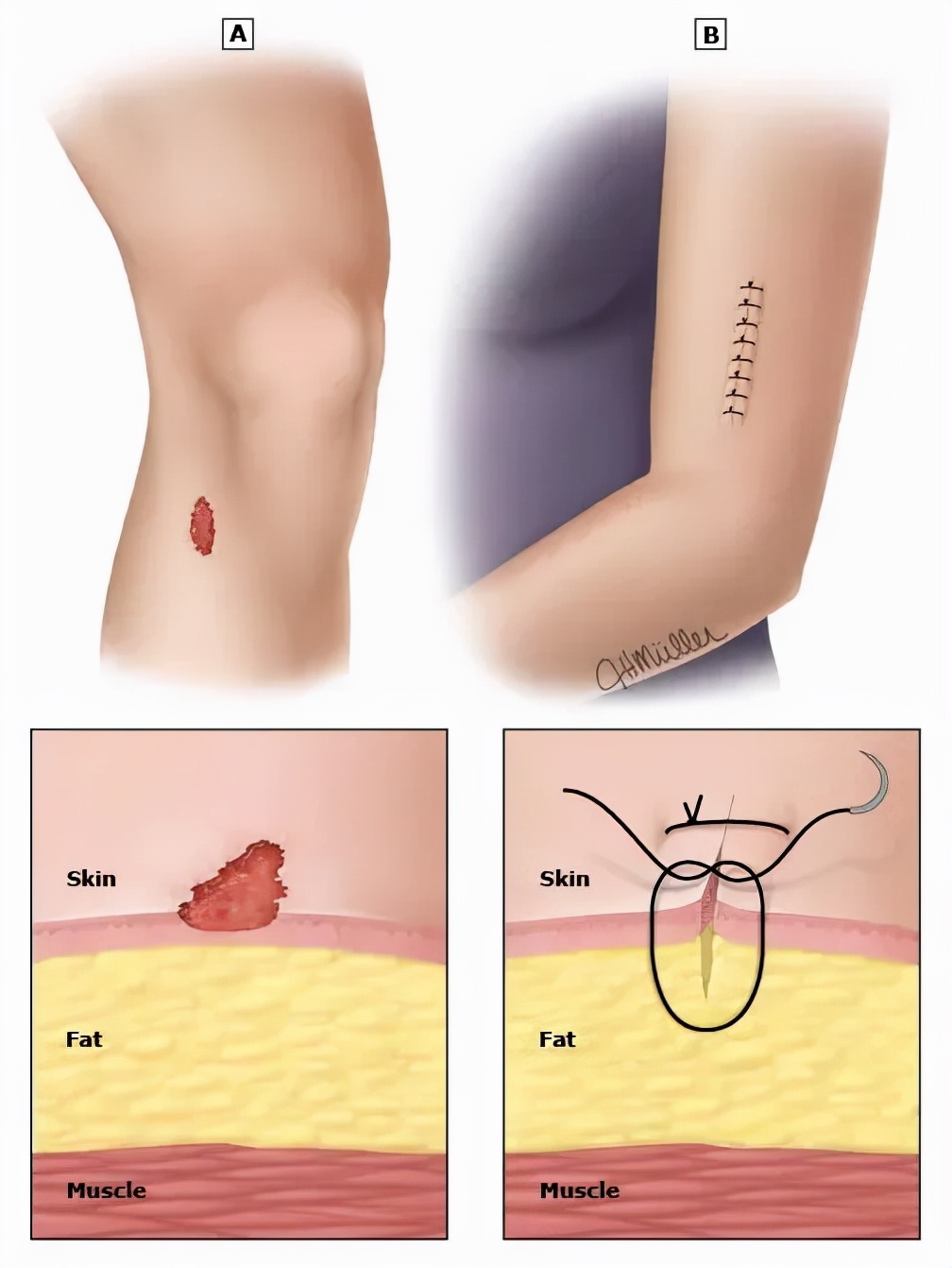 外伤伤口用百多邦好还是碘伏好,外伤是用红药水好还是碘伏好