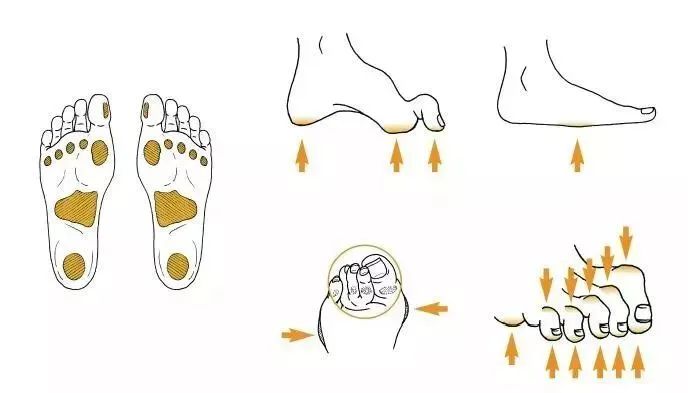 糖尿病足负压护理及观察要点,糖尿病足居家护理