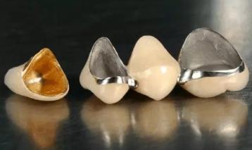 活动牙烤瓷牙全瓷牙种植牙,一颗牙坏了要换三颗烤瓷牙纠结