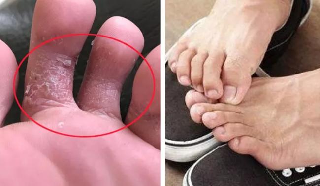 脚后跟干裂脱皮教你一招实用省钱,脚后跟总是干裂起皮的人注意