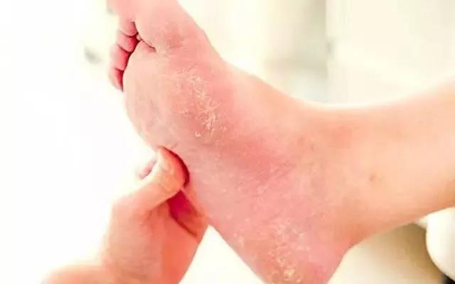 澳洲顶级护脚膏,凡士林手足防裂膏妈妈用