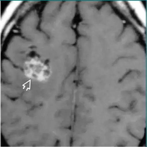 各种囊肿的症状,颅内囊肿18-19mm严重吗