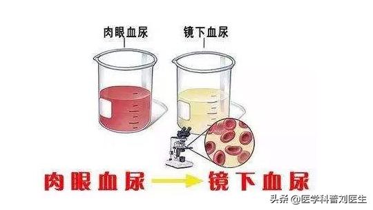 如何关注男性健康,疏通尿管的最好方法