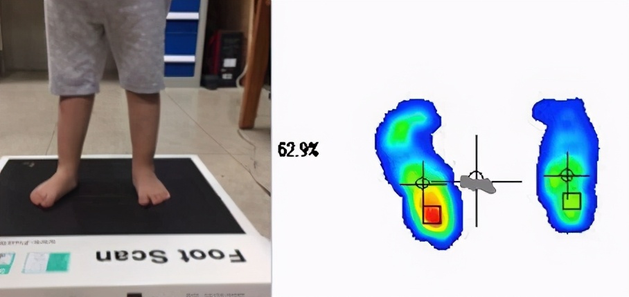 扁平足的腿型怎么改善,扁平足导致腿粗怎么办