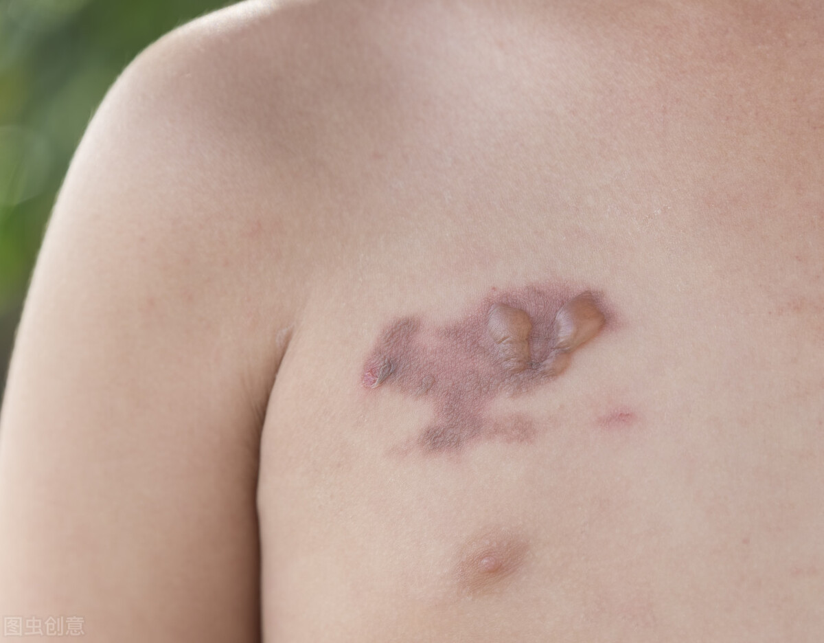 烫伤后留下黑斑怎么办,烫伤后掉了一层皮红红的怎么办