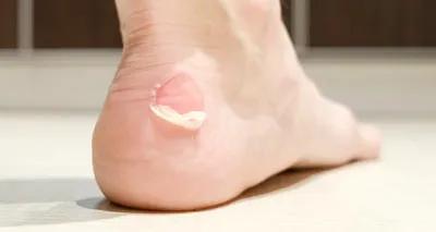 前脚掌疼痛,前足疼