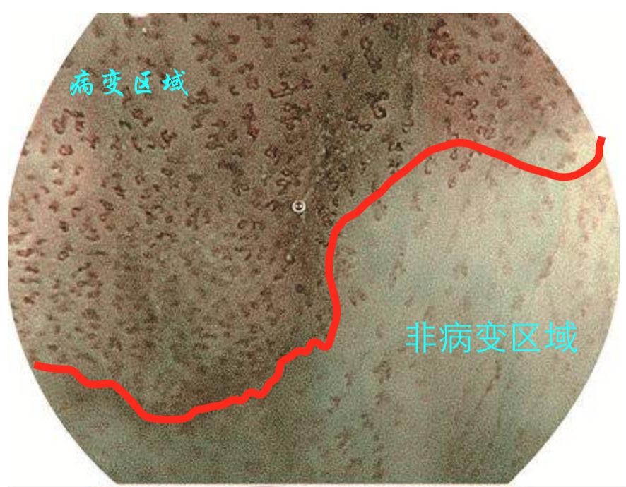 食管癌早期做胃镜能查到吗,食管癌通过胃镜可以检查出来吗