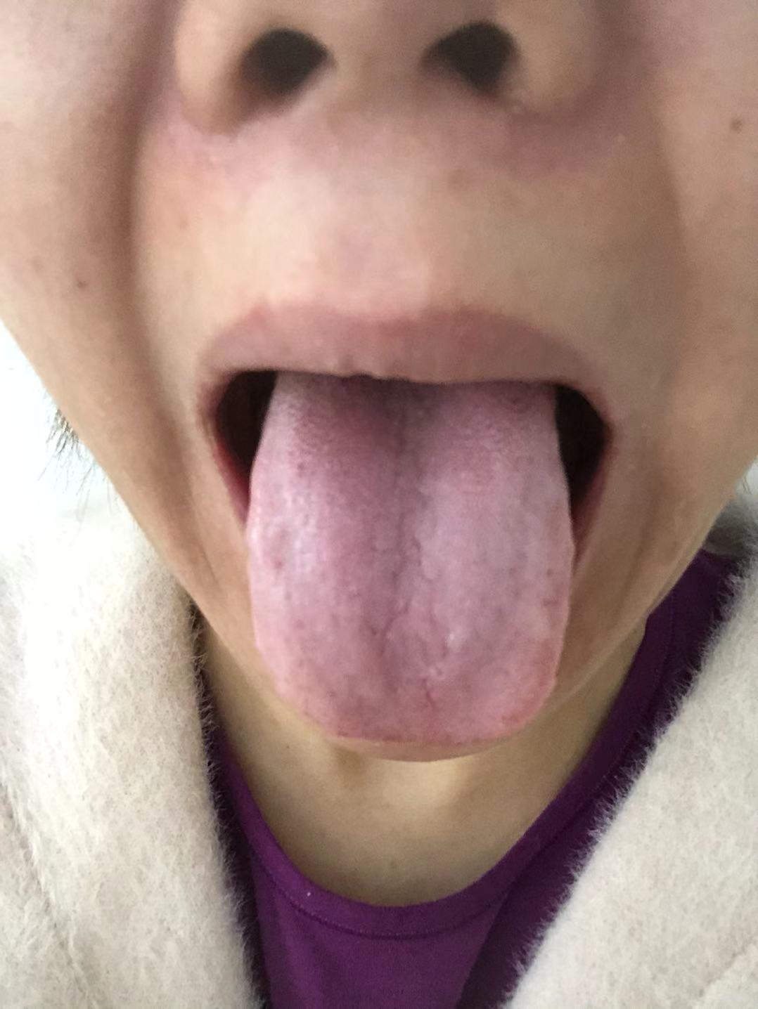 中医治疗眼部皮肤过敏,眼部红肿痒中医治疗