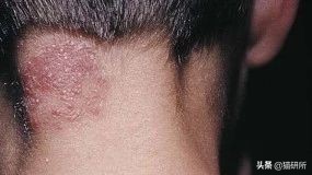 你们的猫咪猫癣怎么治好的,亲身经历的猫癣怎么治