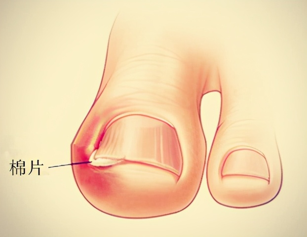 甲沟炎处理视频动画,沉浸式处理甲沟炎