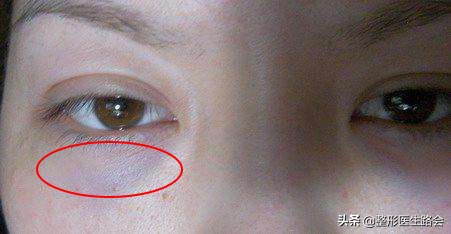 注射泪沟淤青一般需要几天好,胶原蛋白注射泪沟淤青多久能好