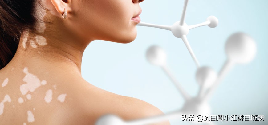 白斑是白癜风还是糠疹如何鉴别呢,怎么辨别白癜风和白斑