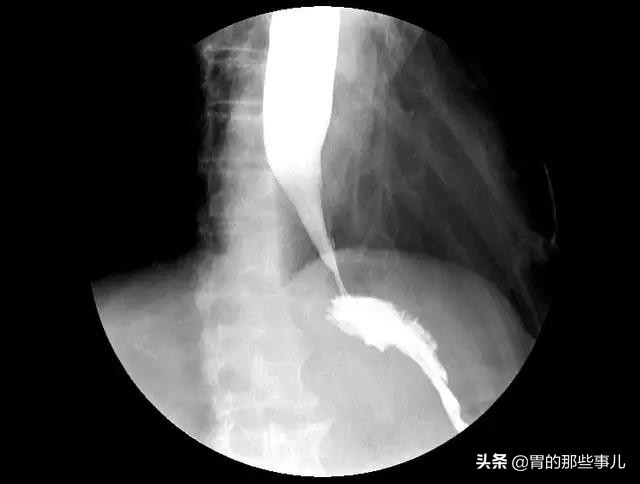 过敏性哮喘该怎么根治,有没有一种病叫过敏性哮喘