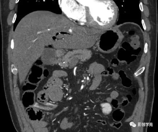 16种常见急性腹痛的诊断与鉴别