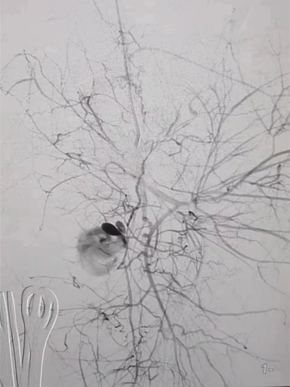 孕妈产后大出血,孕妇产后大出血助产士抢救过程