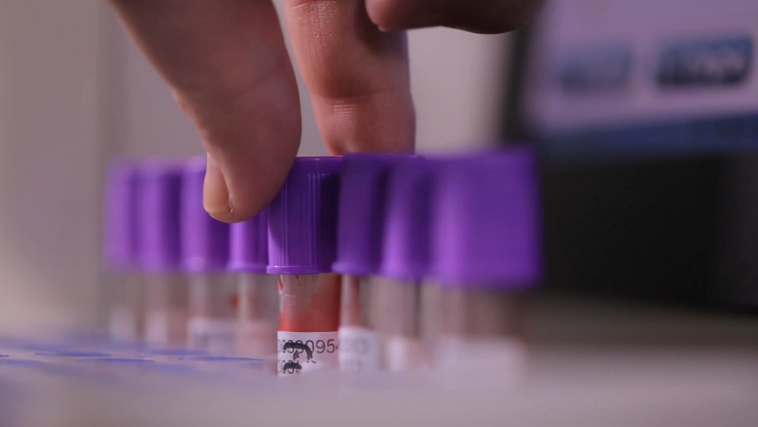 甲亢碘131治疗亲身经历,从甲亢到甲减的最典型症状表现