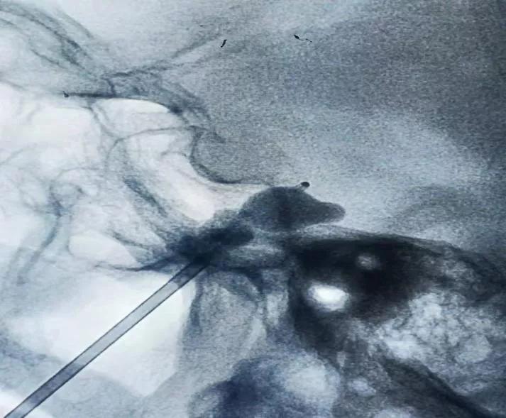 一针治疗颈椎疼痛,杨秉文杨氏一针治疗三叉神经痛