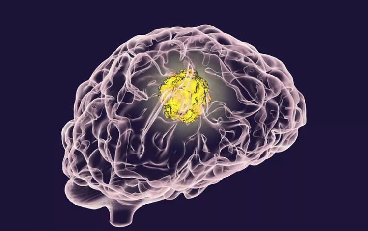 颅内肿瘤引起癫痫能活多久,颅内占位性的病变引起癫痫