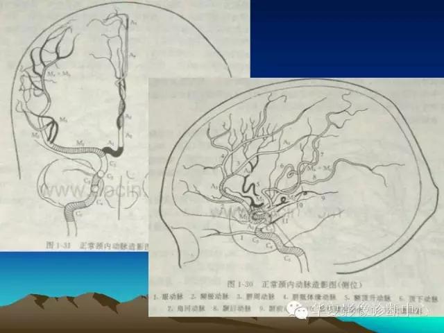 小脑血管解剖分段,脑血管影像解剖讲解