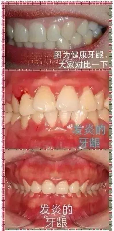 Helen齿科中心——你了解牙龈炎吗？