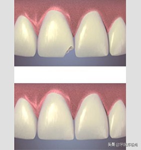 做烤瓷牙为什么要打钉在里面,门牙缺失做全瓷牙需不需要打桩