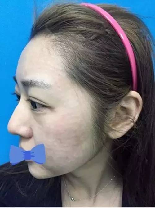 把水光针当饭吃?这位网红简直丧心病狂!整容后年入千万