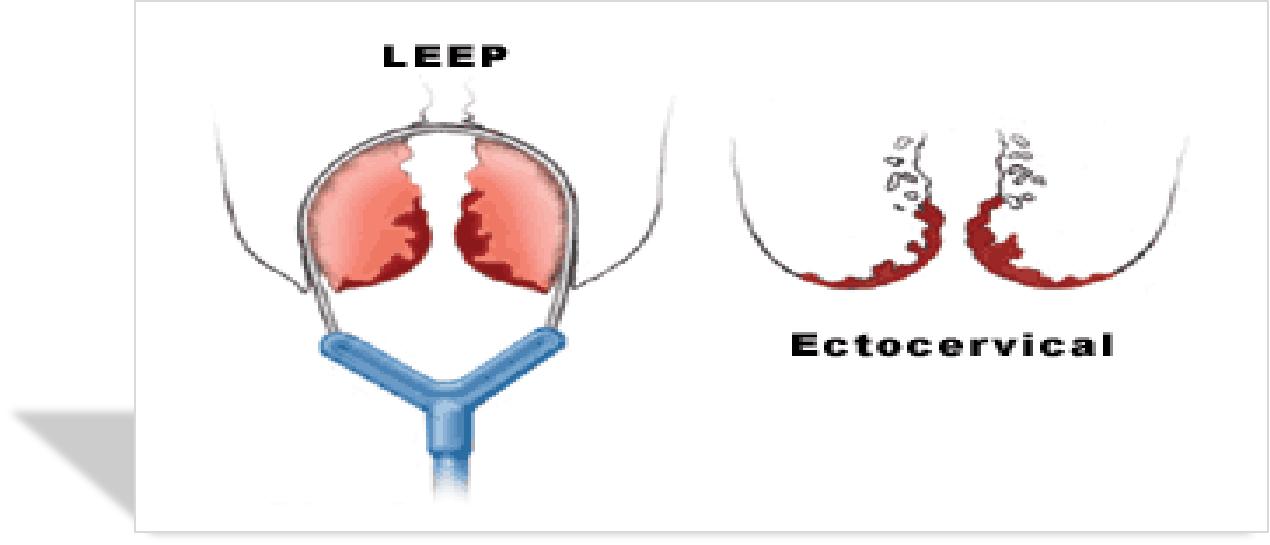 宫颈病变的诊断与治疗科普,宫颈低度病变如何治疗