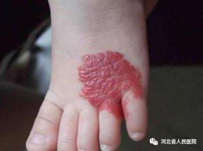 盘点新生儿特有的体征“符号”