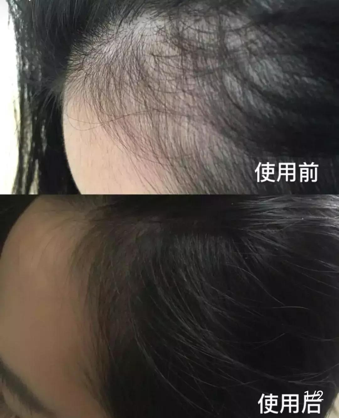 发际线高头发稀疏掉头发怎么拯救,发际线后移的头发还能长出来么