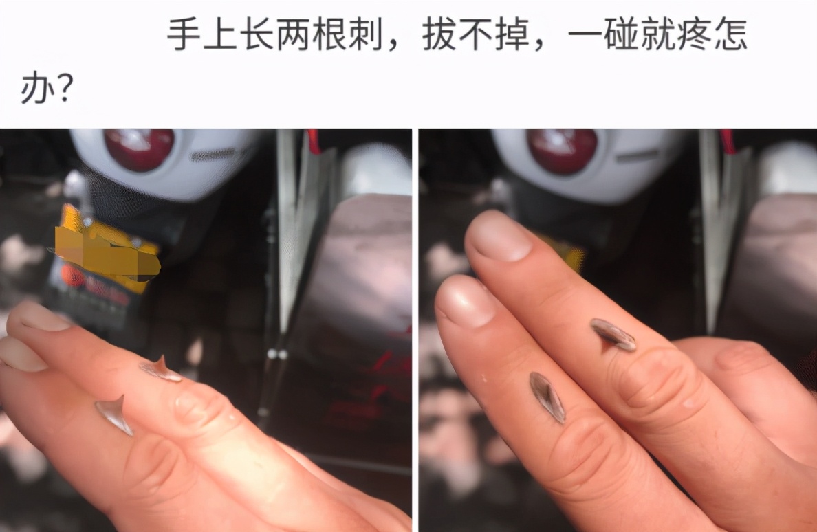 手上长了个手刺怎么办,手上长了一根肉刺很疼