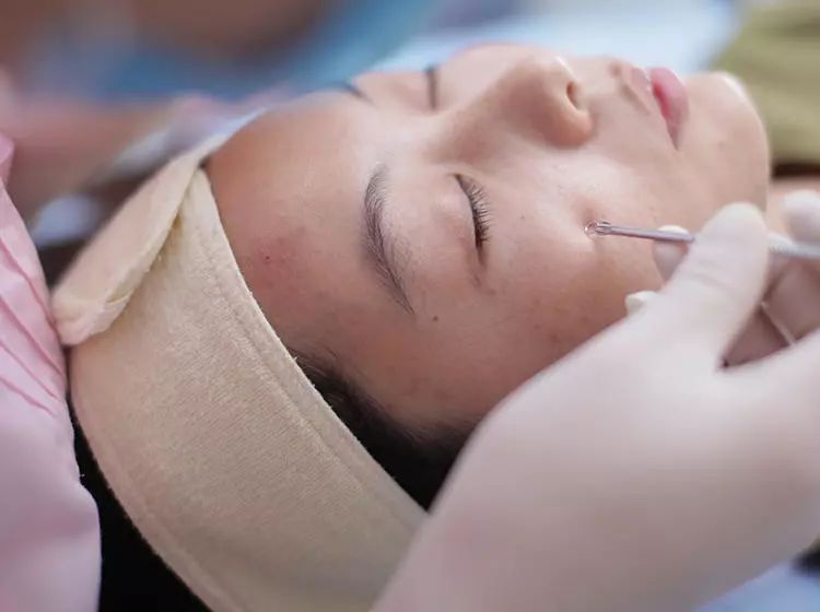 教你快速消灭脸上闭口型痘痘,皮肤科医生教你3步消灭闭口粉刺