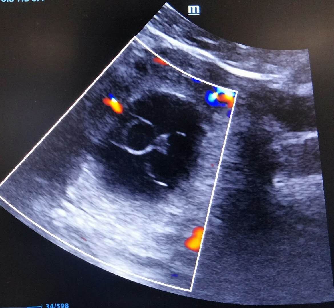 异位妊娠的诊断和治疗，女性朋友都应该知道