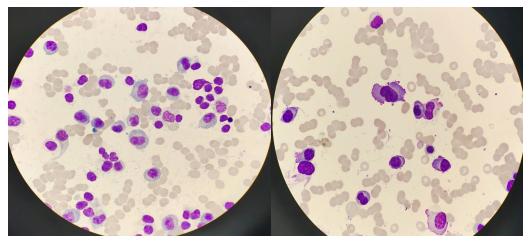 自体BCMA-CART成功治疗伴TP53基因变异及中枢神经浸润难治复发MM