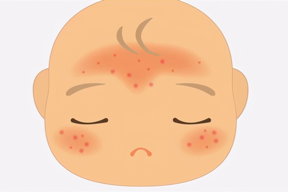 对抗湿疹一招摆平,战胜湿疹