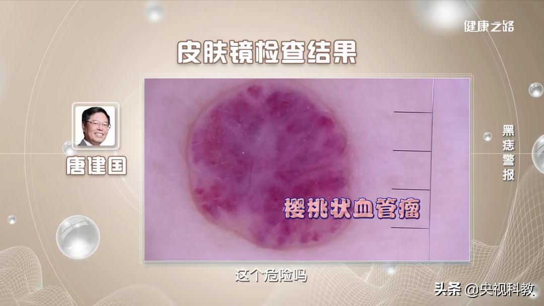 身上的黑痣有癌变的风险吗,身上长黑痣怎样防止恶变
