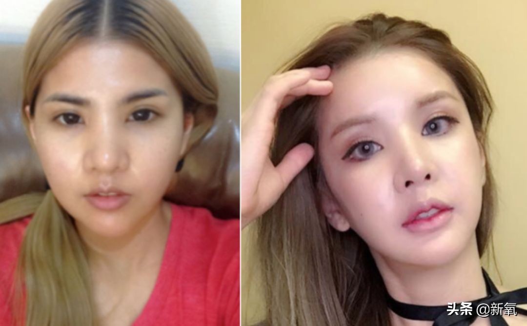 18岁土肥圆豪掷800万全身整形，鼻子6次大整假体穿出，效果却超美