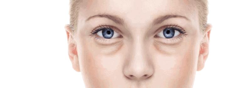 鱼尾纹眼袋怎么去除最有效,眼袋鱼尾纹怎么去除简单方法