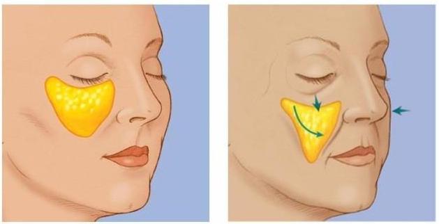 抗衰不再是简单的面部抗衰,风靡全球面部抗衰的最好方法