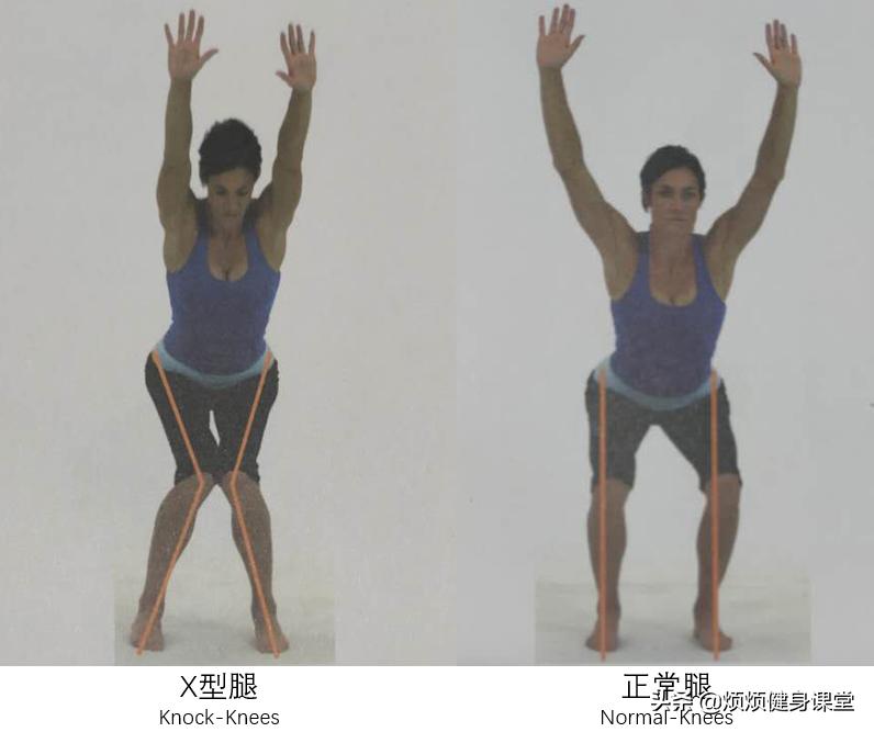 经期怎么改善膝盖内扣,膝盖内扣小腿外翻怎么矫正